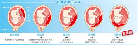 胎盤靠近子宮頸